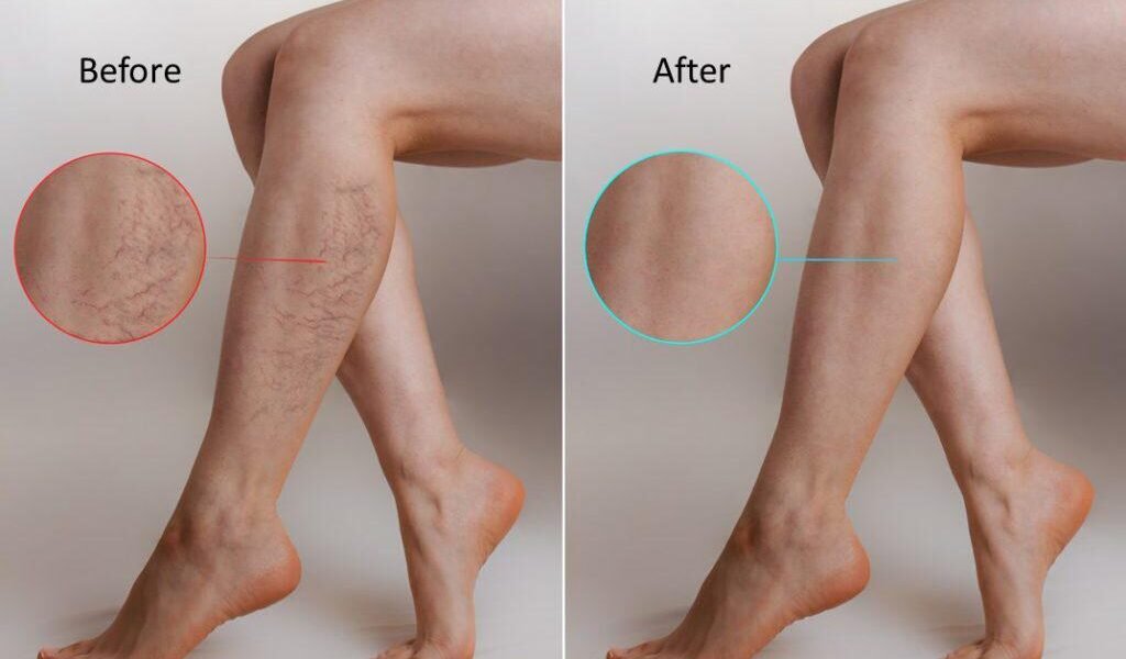 العيادة الطبية التجميلية Carnaby Laser Clinic and Academy تُعالج الأوردة العنكبوتية بواسطة الليزر